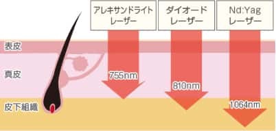 ソプラノチタニウム　3つの波長　照射イメージ